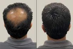 Hair Replacement in Bangalore-Hair Replacement Center