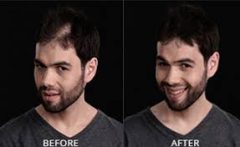 Hair Fixing in Bangalore-Hair Fixing Services-Hair Fixing Treatment-Hair Weaving Services