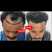 Best Hair Transplant Clinic in Agra | Memas