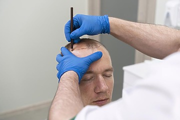 how long does a hair transplant take featured image by freepik 360x240 1