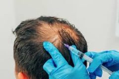 Hair Transplant Clinics in Bangalore | Hair Transplant Cost