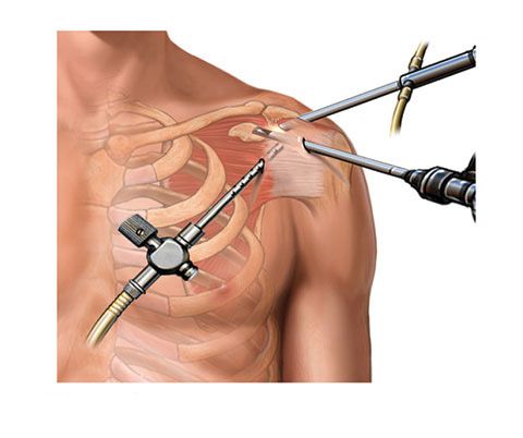 os26 arthroscopy shoulder 2