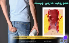 Effective Hemorrhoid Treatment: Your Guide to Finding Relief Hemorrhoids, also commonly known as Bavasir, refer to swollen and inflamed blood vesse...