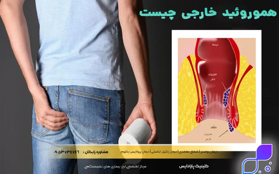 هموروئید خارجی چیست