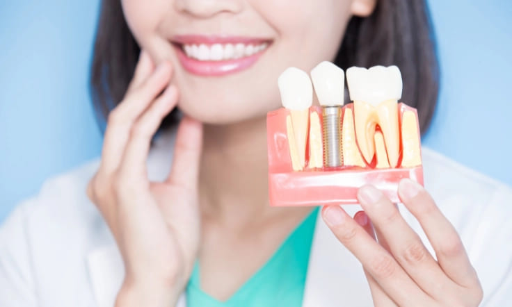 dental implants