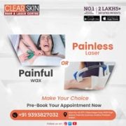Pulse dye laser treatment in india