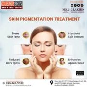 Best Vitiligo Treatments in india | clearskinandhair.in
