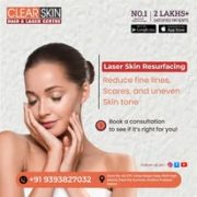 Best Advanced Acne Laser Treatment in India