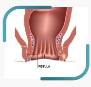 Best Fistula Treatment in India | Expert Fistula Doctor in Pune – Kaizen Gastro Care