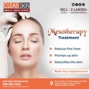 best vbeam laser treatment in india