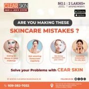 best vbeam laser treatment in india